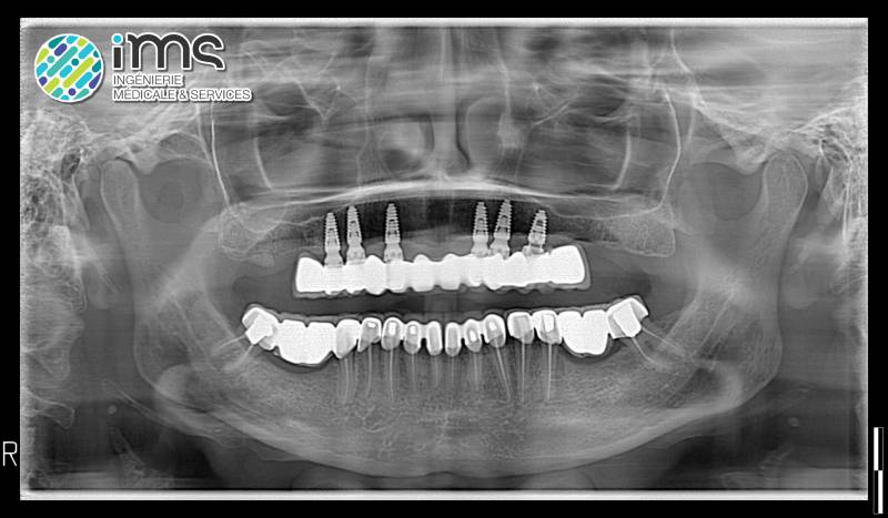 Panoramique / Conebeam OWANDY iMAX3D, système ouvert avec les caméras d'empreinte optique (MEDIT i700, etc.) et les imprimantes 3D.