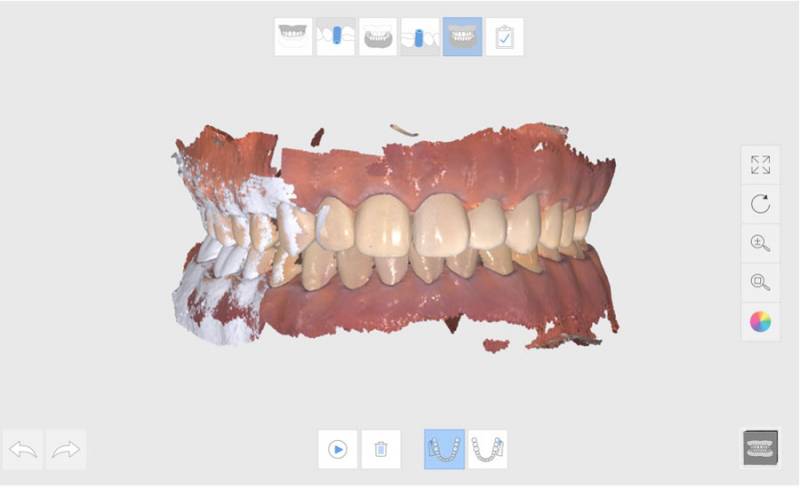 MEDIT i500 : le scanner intraoral le moins cher du marché, le plus ouvert et probablement le plus précis ... sans frais de licence ni de mise à jour !