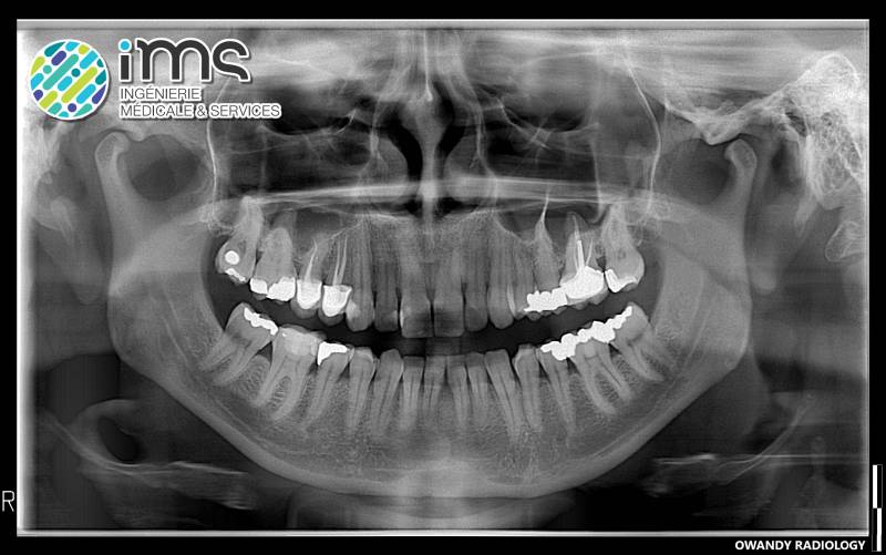 Panoramique / Conebeam OWANDY iMAX3D, système ouvert avec les caméras d'empreinte optique (MEDIT i700, etc.) et les imprimantes 3D.