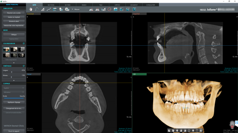 Conebeam VATECH Green X, conebeam 16x9