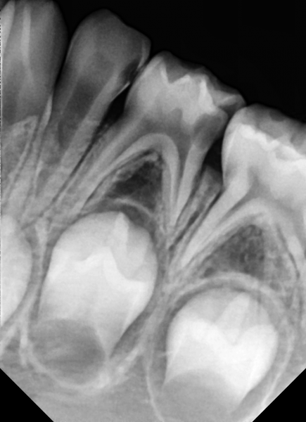 Capteur de radiologie numérique VATECH EZ Sensor Classic. 3 tailles au choix : 1, 1.5, 2. Existe également en version 