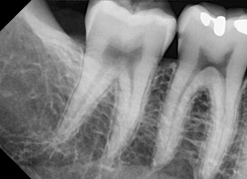 Capteur de radiologie numérique VATECH EZ Sensor Classic. 3 tailles au choix : 1, 1.5, 2. Existe également en version 