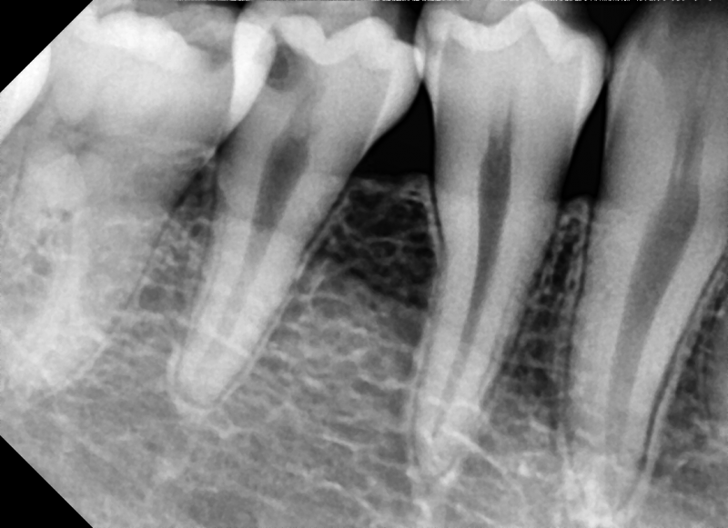 Capteur de radiologie numérique VATECH EZ Sensor Classic. 3 tailles au choix : 1, 1.5, 2. Existe également en version 