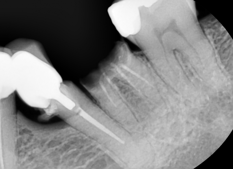 Capteur de radiologie numérique VATECH EZ Sensor Classic. 3 tailles au choix : 1, 1.5, 2. Existe également en version 