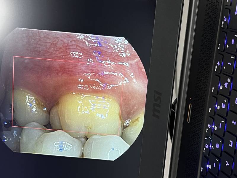 Scanner intraoral BIOTECH WoW, images en couleurs réelles !