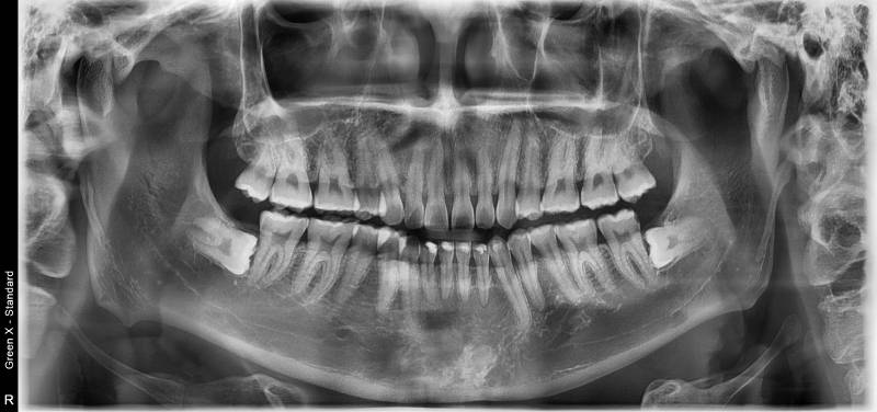 Conebeam VATECH Green X