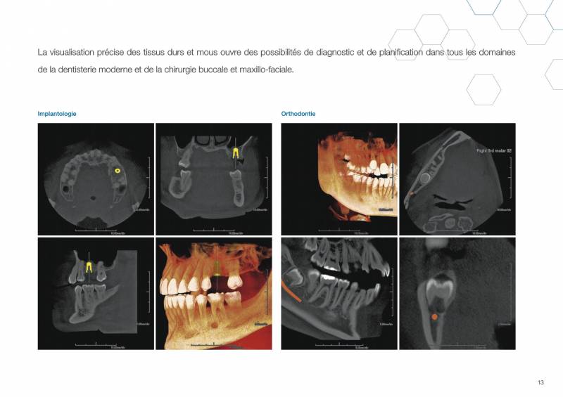 Conebeam PREXION 3D Explorer PX1 (15x16) - Cas cliniques implantologie et orthodontie