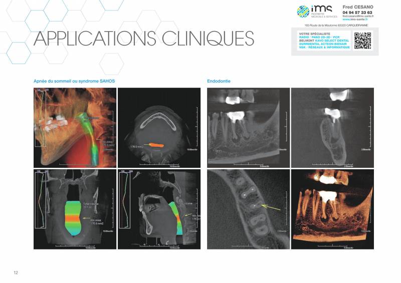 Conebeam PREXION 3D Explorer PX1 (15x16) - Cas cliniques apnée du sommeil et endodontie