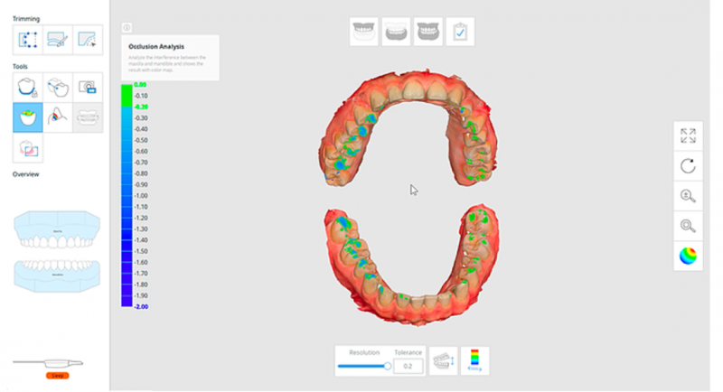 La fonction d'analyse d'occlusion affiche l’interférence entre le maxillaire et la mandibule sur une carte en couleur très claire